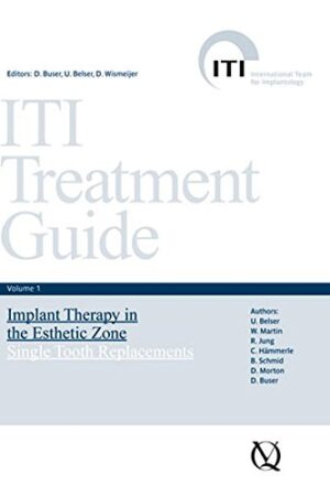 ITI Treatment Guide: Implant Therapy in the Esthetic Zone - Single-tooth Replacements v. 1